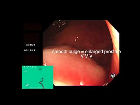 वीडियो: कॉलोनोस्कोपी के दौरान प्रोस्टेट की जांच की जाती है?