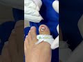 Fibroma cubre gran parte de la uña😰 #satisfying #ingrown_toenail_surgery
