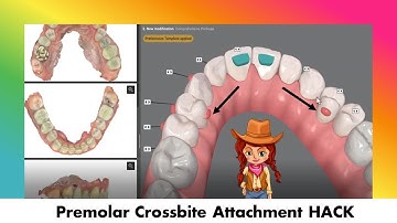 Invisalign ClinCheck - Attachment HACK to Correct a Premolar Crossbite