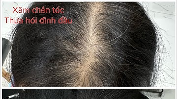 Review xăm hói đỉnh đầu nam nữ, xăm tóc hói đỉnh đầu cho nữ