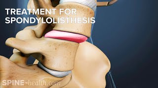 Treatment for Spondylolisthesis