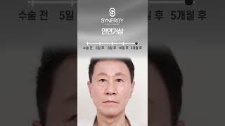 #Shorts #안면거상 #동안성형 이렇게 젊어져도 되나요? 60대 남성 안면거상술 전후 모습 공개👀 【feat. 시너지성형외과】