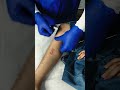 महिलाओं की सफेद पानी (Leucorrhea) की समस्या में राहत देगा ये 1 Acupressure #ytshorts #acupuncture