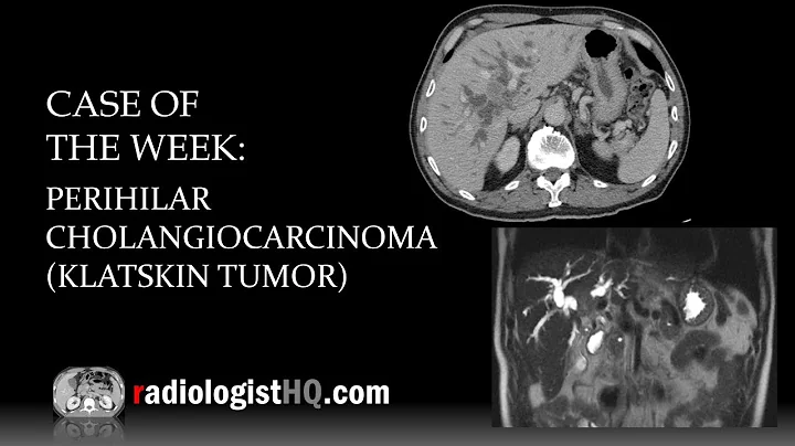 Case of the Week: Perihilar Cholangiocarcinoma/Klatskin Tumor (CT & MRI) - DayDayNews