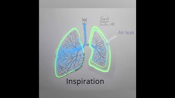 Tension Pneumothorax explained in 1 minute