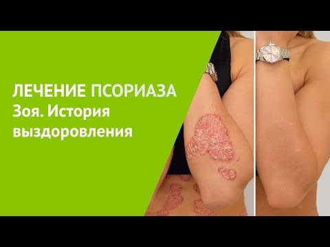 Чем лечить псориаз на голове в домашних условиях народными средствами