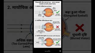 explanation myopia and its treatment #uppcs #mppsc #ssc #mpboard #prelimsexam #pyq