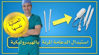 العملية نفسها - استبدال الدعامة المرنة بالدعامة الهيدروليكية المتطورة - تكبير الحجم - على يد خبير