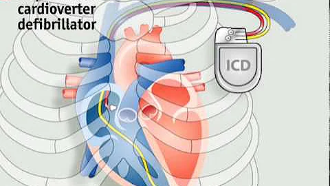 How pacemakers work