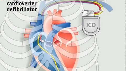 Hoe pacemakers werken