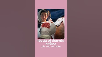 Tóc Cấy Duy Trì Vĩnh Viễn Được Không?? #caytoctuthan #caytoc #hói_da_đầu #hairtranplantresult #pttm