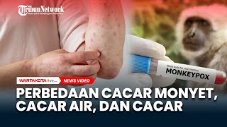 Cacar Monyet, Cacar Air, dan Cacar Sekilas Mirip, Inilah 8 Perbedaannya