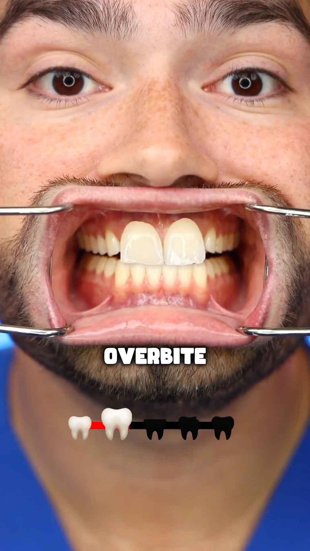 Tooth Shape Meaning !?