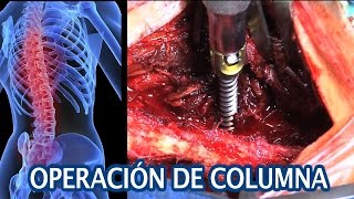 Neuropatía de puede cirugía periférica la espalda causar
