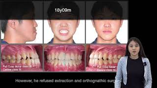 Non-extraction treatment of Class III malocclusion with Invisalign｜【Chris Chang Ortho】CC650