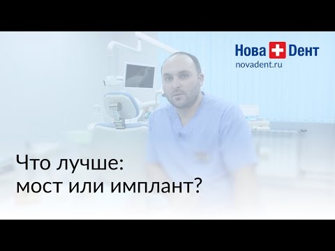 Что лучше мост или имплант