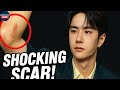 Wang Yibo’s Serious Elbow Injury Sends Shockwaves Through the Entertainment World