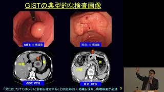 GISTの基礎知識　本間義崇