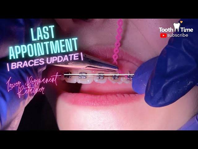 My Last Braces Checkup - Bending orthodontic wire - Tooth Time Family  Dentistry New Braunfels 