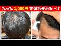 【暴露】最安で薄毛・AGAを治す方法4選💡 治療歴5年以上が解説します