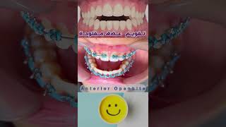 شرط اساسي tongue story stop dr_eslam_nabil teeth braces طبيب_اسنان تقويم أسنان تبييض
