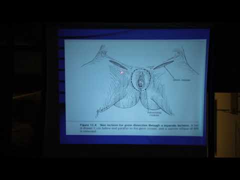 Vulvar cancer - Gynecologic Oncology review - Dr Gari