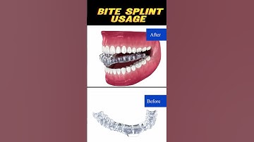 "What’s a Bite Splint? The Dental Secret to Stop Night Grinding!