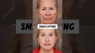 Even a subtle change can shift the whole impression. #FacialLifting #aestheticsurgery