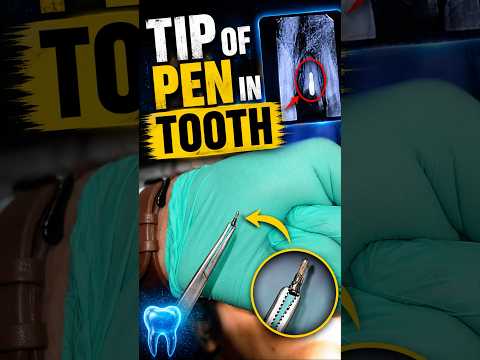 Tip of Pen in Tooth