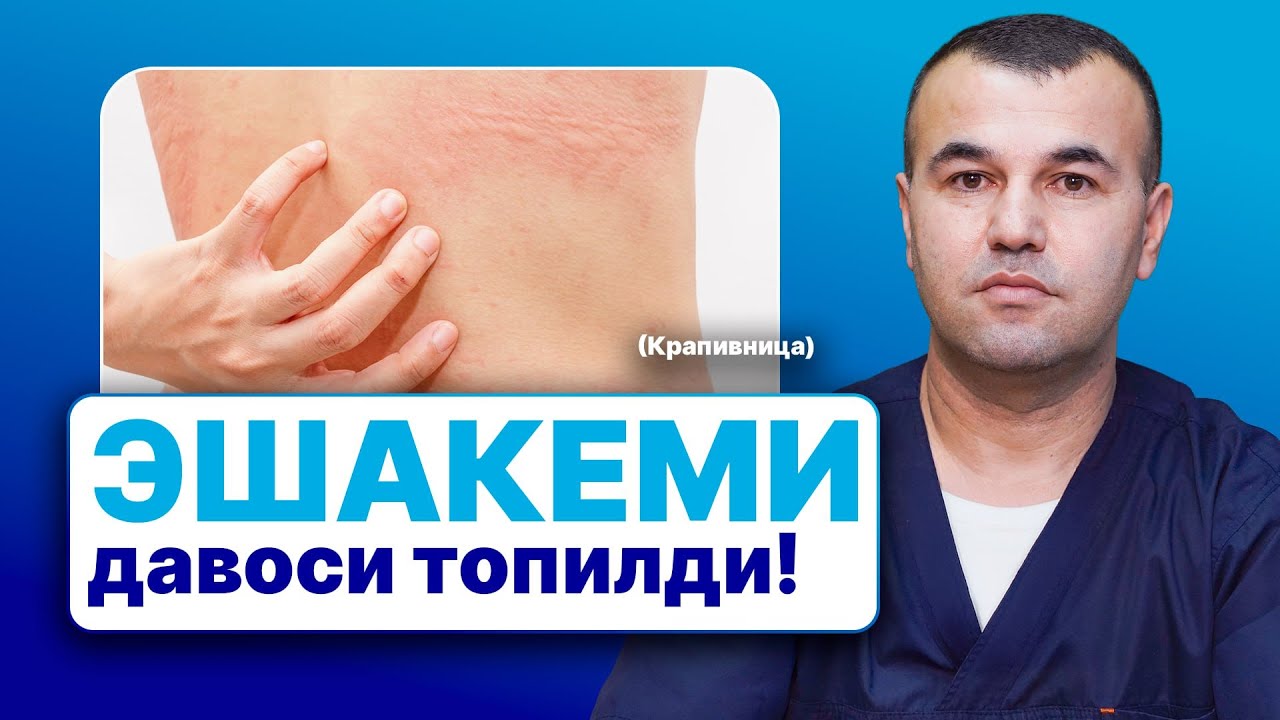 Эшакеми, Крапивница — сабаблари ва даволаш усуллари | 90 788 83 13
