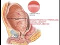 Benign Prostatic Hyperplasia (BPH) Part 2 of 2 - An Easy Explanation