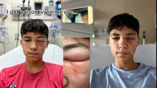 What it’s like to get poison ivy in your eye… What it’s like to get poison ivy in your eye…