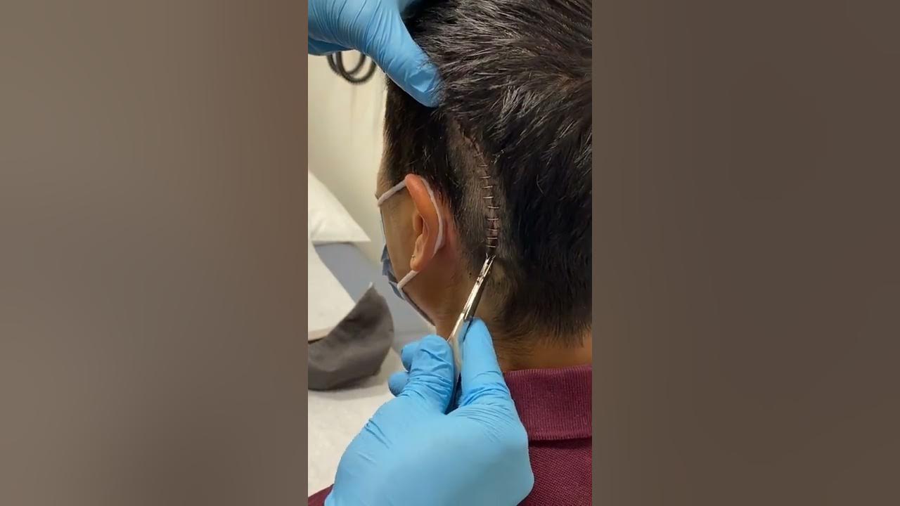 Staple removal; post surgery YouTube