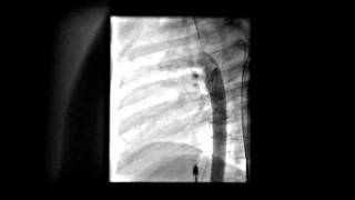 PDA device closure   Aortogram post device release