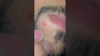 3 months transformation #beard #pimple