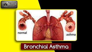 Summary of Bronchial Asthma