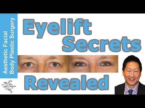 Must see Eyelift Secrets Revealed. Learn the Basics on Browlift, Upper & Lower Eye Lift, Seattle