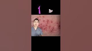 Sering jerawatan pada Miss V? #tipswanita #kesehatanmissv #kesehatanwanita #jerawat #viral