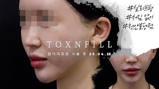 브이라인 얼굴 원한다면 원더리프트 시술 영상 톡스앤필 천안불당점 아산 피부과, 리프팅