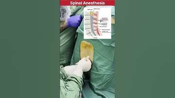 How spinal Anesthesia procedure is performed in Surgery #doctor #mbbs #neet #medical #anesthesia
