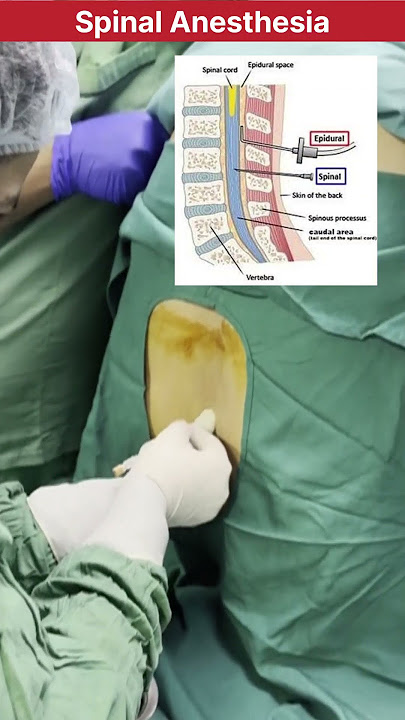 How spinal Anesthesia procedure is performed in Surgery #doctor #mbbs #neet #medical #anesthesia