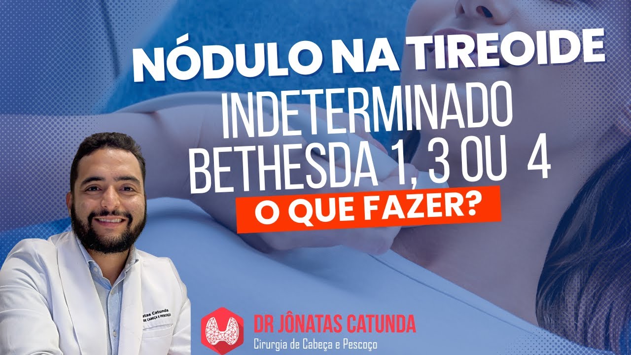 Nódulo na tireoide - punção indeterminada, Bethesda 1, 3 ou 4