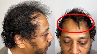 he almost gave up on his Hairline before coming to me, What Next?