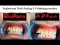 Multan aesthetics professional teeth scaling and polishing  dr talha ashar