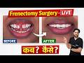 Frenectomy Procedure 😮 Gap Closed Without Braces? Full Process Explained | Indore