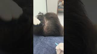 #dreamhairline #hairrestoration #hairlossclinic#hairtreatment #prptreatment #stemcelltreatment