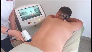 Centar Za Epilaciju - Epilacija Ledja - Alma Laser