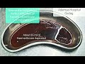 Minimally displaced fracture Medial condyle Tibia | Knee Aspiration & Cnsrvative treatment | Adamya