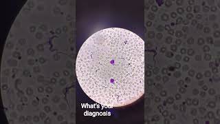 This is clear depiction of Trypanosomiasis.