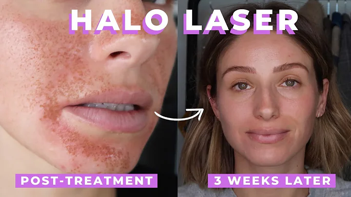 Effektiv Halo Laser-behandling för hudpigmentering